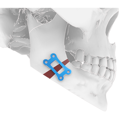 Img implante en titanio para cirugía ortognática mandibular vista lateral