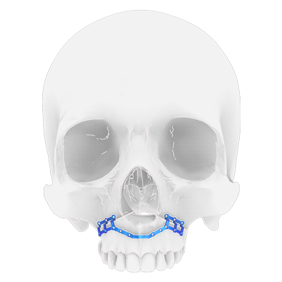 Img implante en titanio para cirugía ortognática maxilar