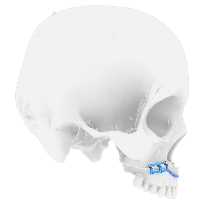 Img implante en titanio para cirugía ortognática maxilar vista lateral