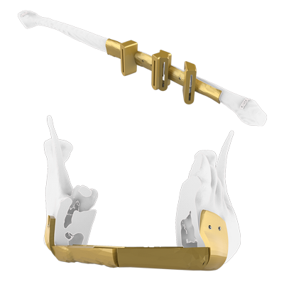 Img guía quirúrgica para reconstrucción mandibular con colgajos de peroné