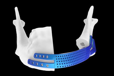 Img reconstrucción mandibular