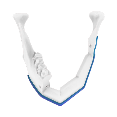 Img implante en titanio para reconstrucción mandibular con colgajos de peroné vista superior