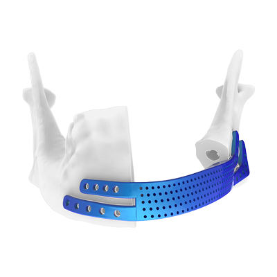 Img implante en titanio para reconstrucción mandibular con placas anatómicas vista frontal