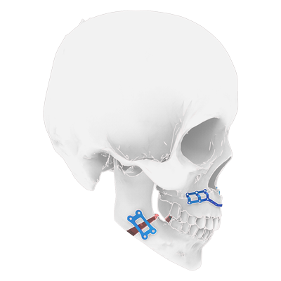 Img implante de titanio para cirugía ortognática maxilomandibular vista lateral