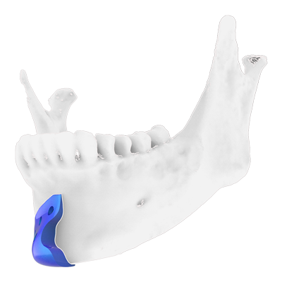 Img implante de titanio para genioplastia pieza 1